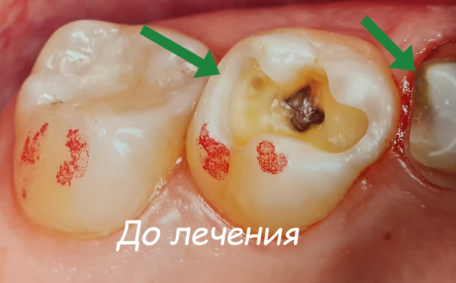 Кариес на жевательном зубе до лечения