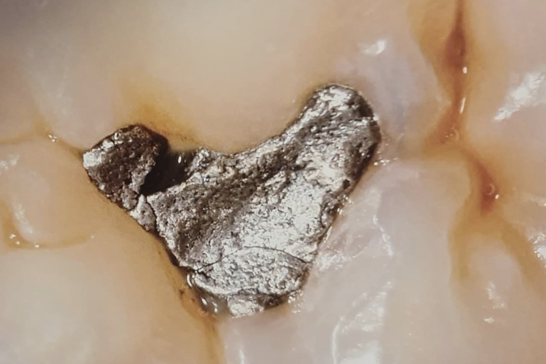 Пломба из амальгамы крупным планом