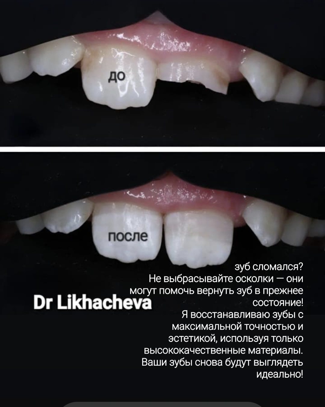 Скол переднего зуба: до и после реставрации