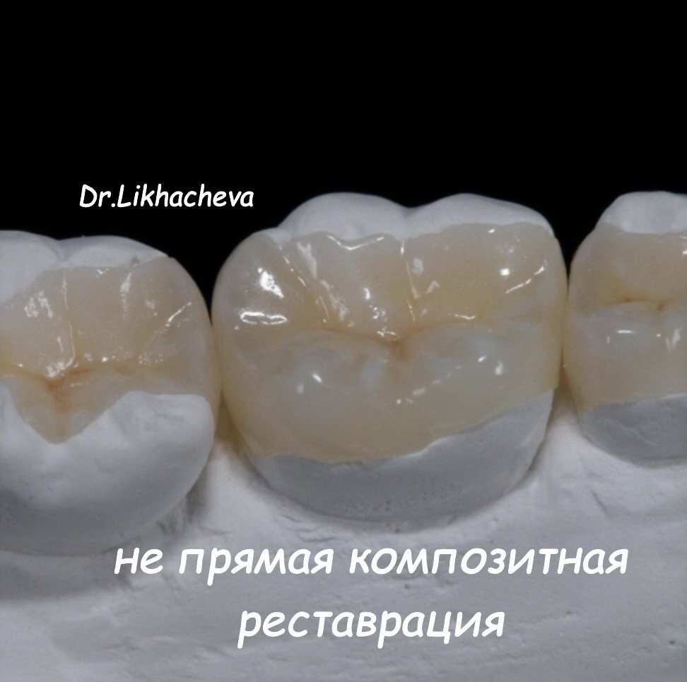 Непрямая композитная реставрация на модели